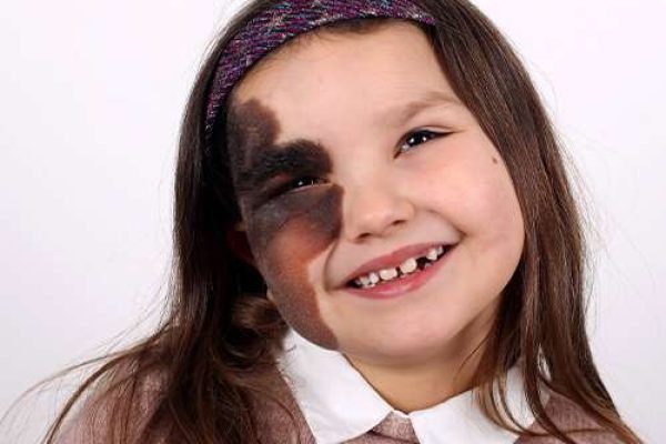 what is birthmark removal treatment best birthmark removal treatment in Lahore, best skin specialist in Lahore,